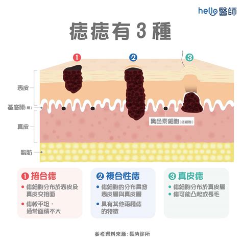 為何會長痣|痣形成的原因？痣長毛、痣變多變大是痣病變？5招判別